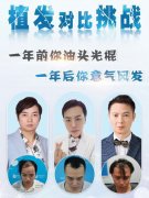 在广州正规的植发医院植发需要多少钱