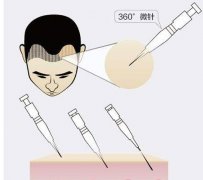 广州植发医院技术有何区别