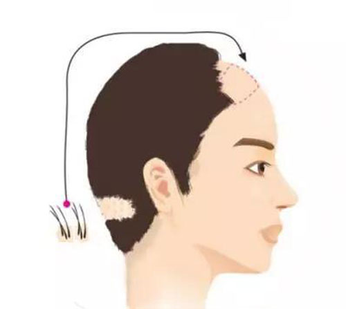 植发手术是将后枕部健康毛囊提取出来后，在移植到脱发区域