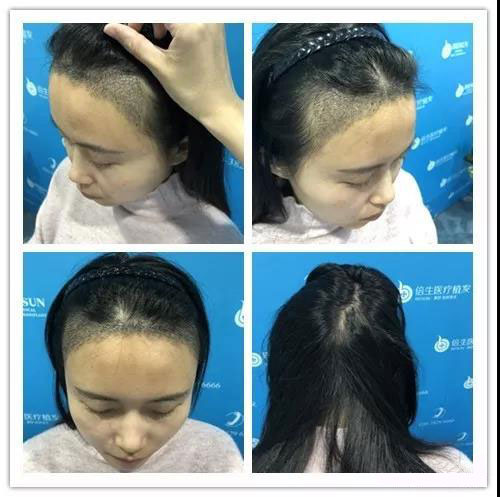 广州女性头发加密效果