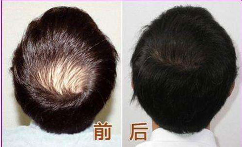 广州植头发多少钱？