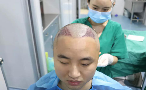 在广州植个头发要几多钱啊？