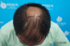 广州倍生植发医院治疗秃顶效果好不好