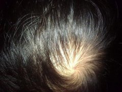 头顶稀疏了头发怎么处理呢？现代植发技术能解决吗？