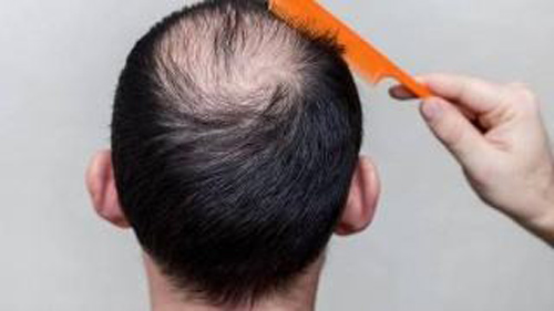 广州植发医生杨晓谈头发种植,头发不是你想植就能植的