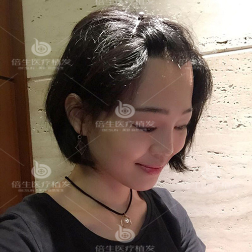 广州倍生植发的发际线调整手术如何，看看她们就知道了