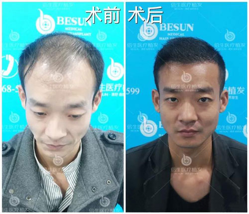 植发费用多少钱？在广州怎么才可以用最少的钱做好植发手术？