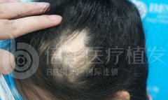瑞士NAT美学植发技术是治疗脱发最好的吗