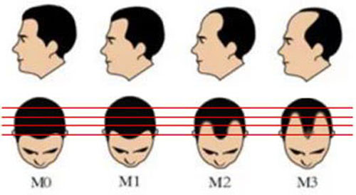 “M”型号发际线