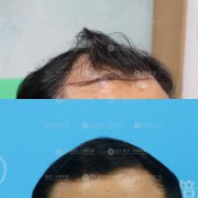 广州植发是不会对头皮造成伤害的