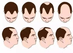 广州植发能治疗雄激素脱发
