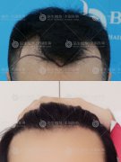广州植发能改善发际线过高的问题