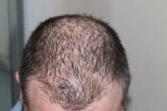 脂溢性脱发、雄激素性脱发、遗传性脱发，是一回事吗？